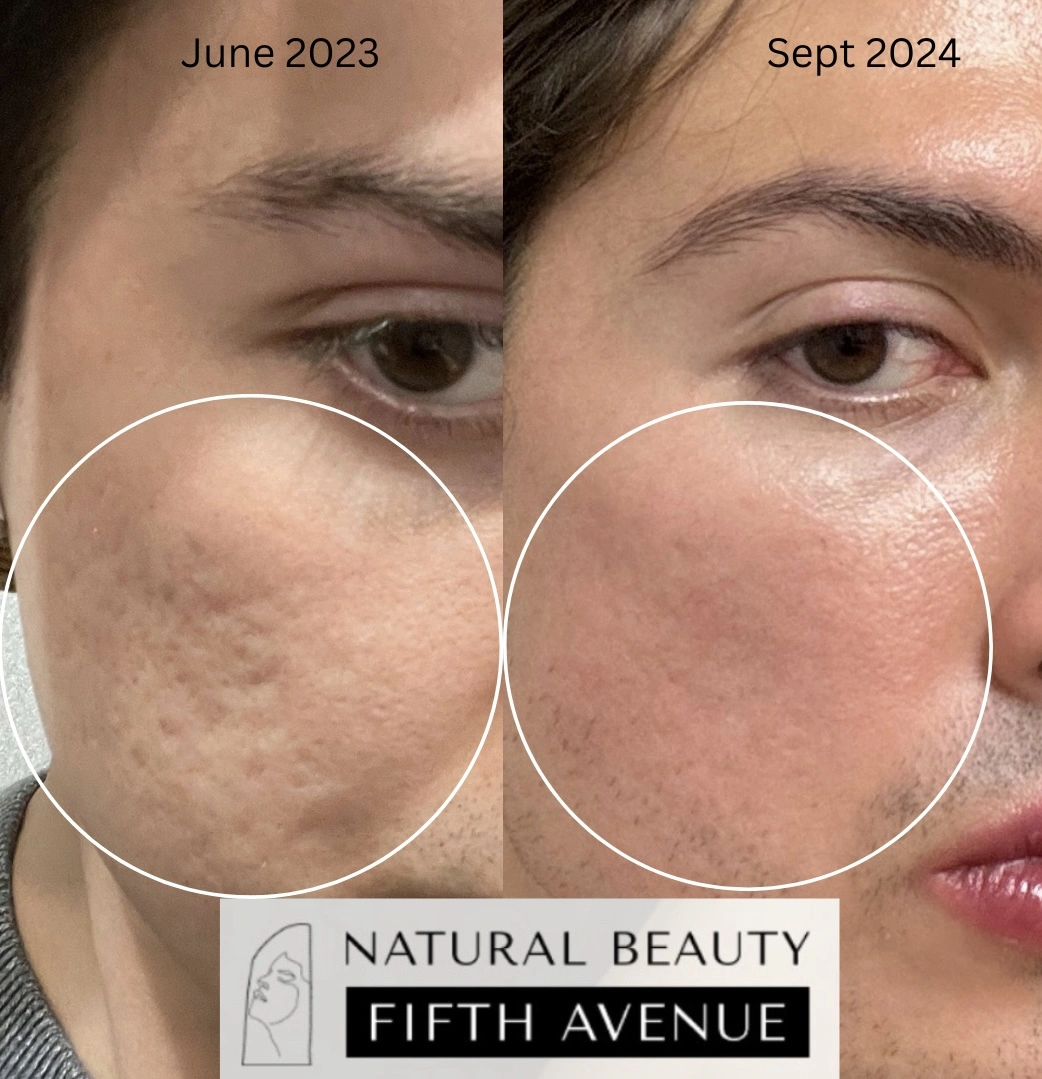 Before and after acne scar treatment: June 2023 showing textured scarring on cheek; September 2024 showing smoother, clearer skin